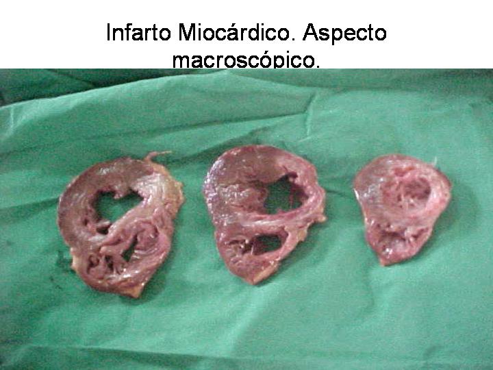 INFARTO MIOCARDICO - <div style=